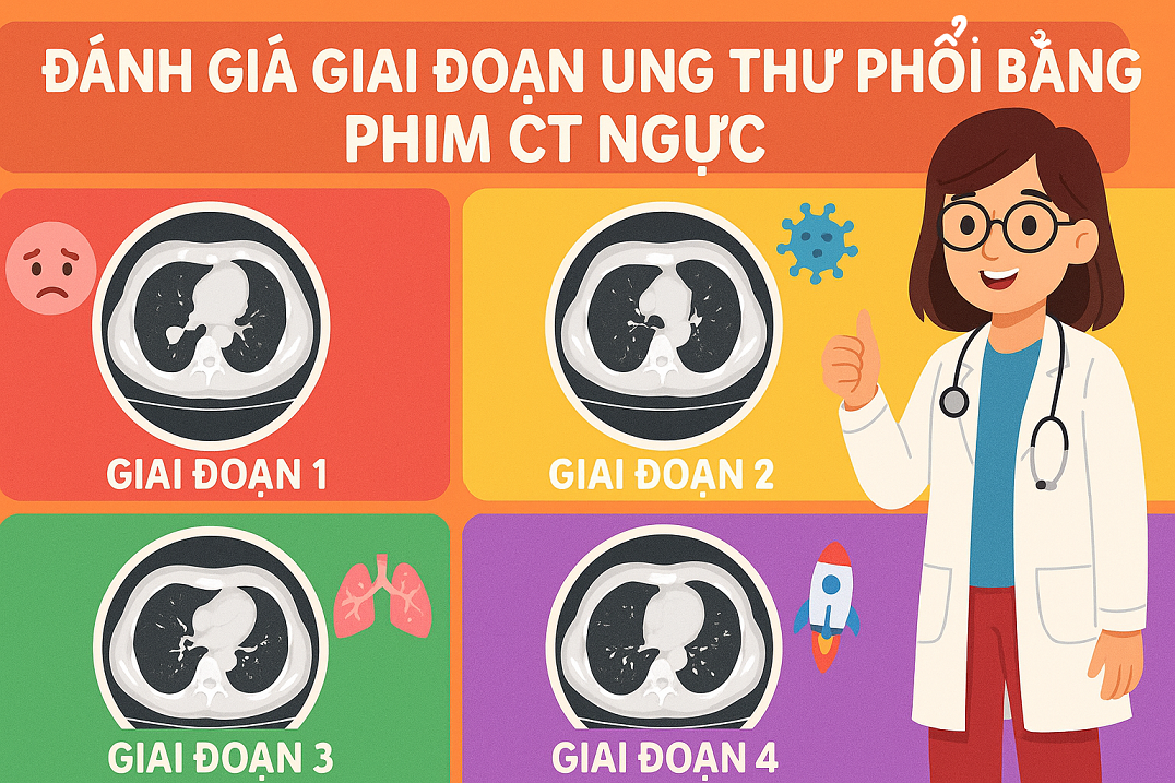 Vai Trò Phim CT Ngực Trong Đánh Giá Giai Đoạn Ung Thư Phổi: Hiểu Đúng, Phát Hiện Sớm