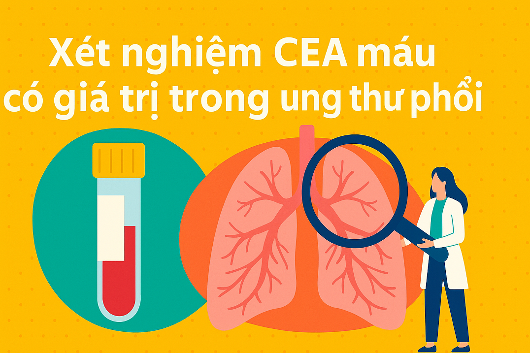 Xét nghiệm CEA trong Ung Thư Phổi: Những Điều Bệnh Nhân Cần Biết